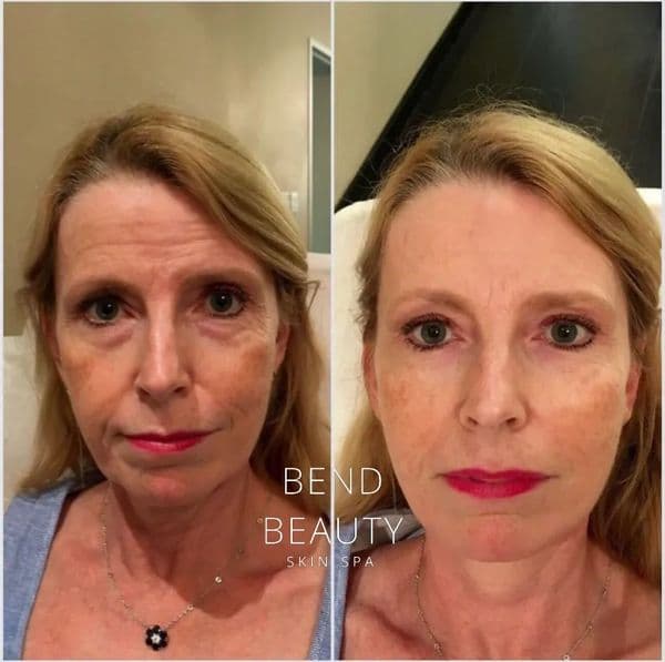 Bend Beauty Spa client result, before and after 1 of 8