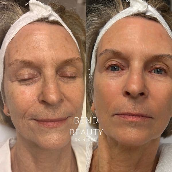 Bend Beauty Spa client result, before and after 2 of 8