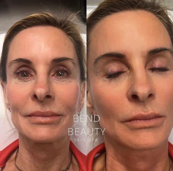 Bend Beauty Spa client result, before and after 3 of 8