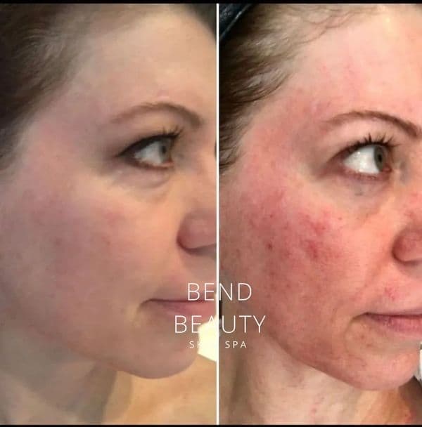 Bend Beauty Spa client result, before and after 4 of 8