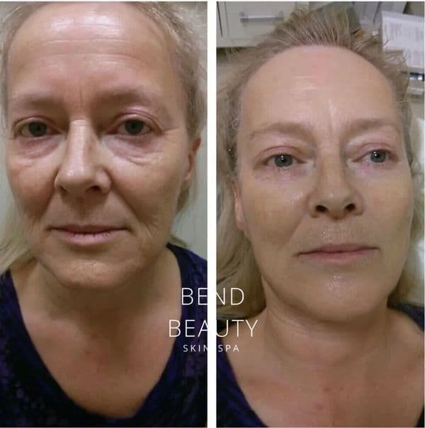 Bend Beauty Spa client result, before and after 5 of 8