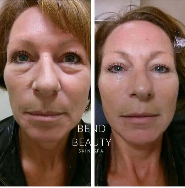 Bend Beauty Spa client result, before and after 6 of 8