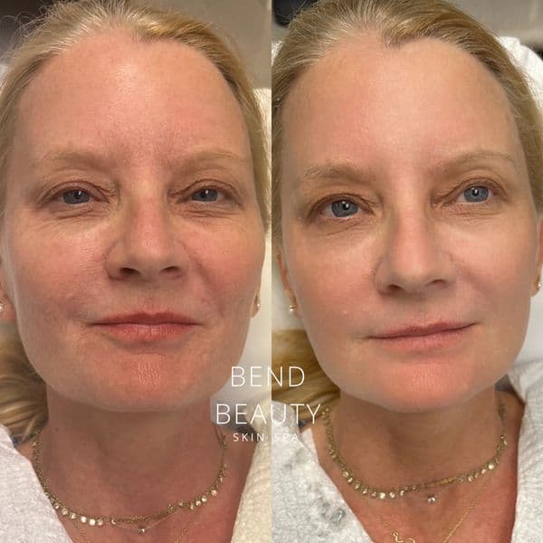 Bend Beauty Spa client result, before and after 7 of 8