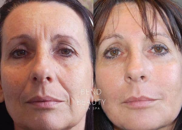 Bend Beauty Spa client result, before and after 8 of 8